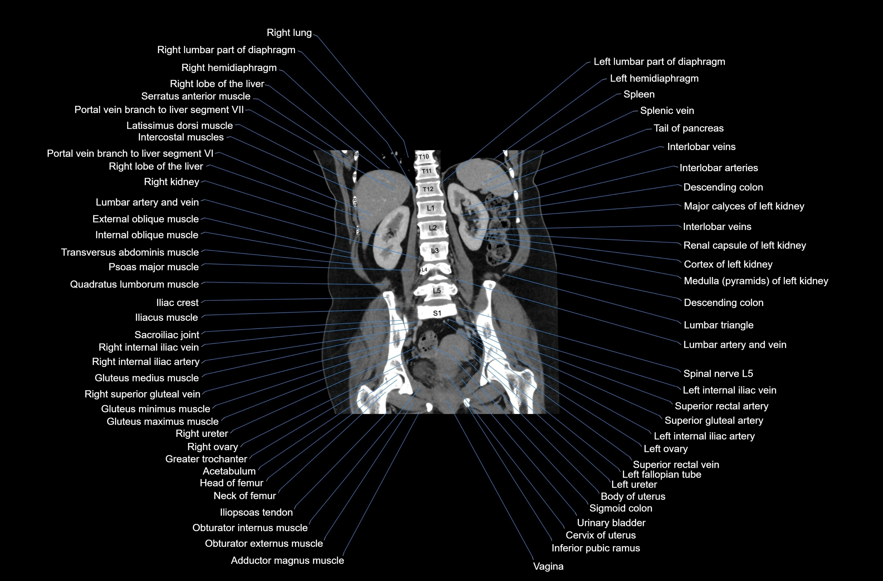 CT abdomen coronal cross sectional anatomy labelled radiology image-00058.webp